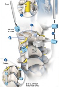 plif surgery and corebella